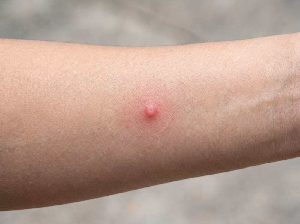 Close-up photograph of mild red skin irritation on a forearm caused by contact with sticky honeydew residue rather than an insect bite